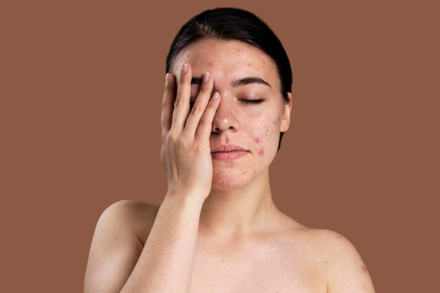 Hyperpigmentation - Causes and Treatment Options - Dr Rashmi