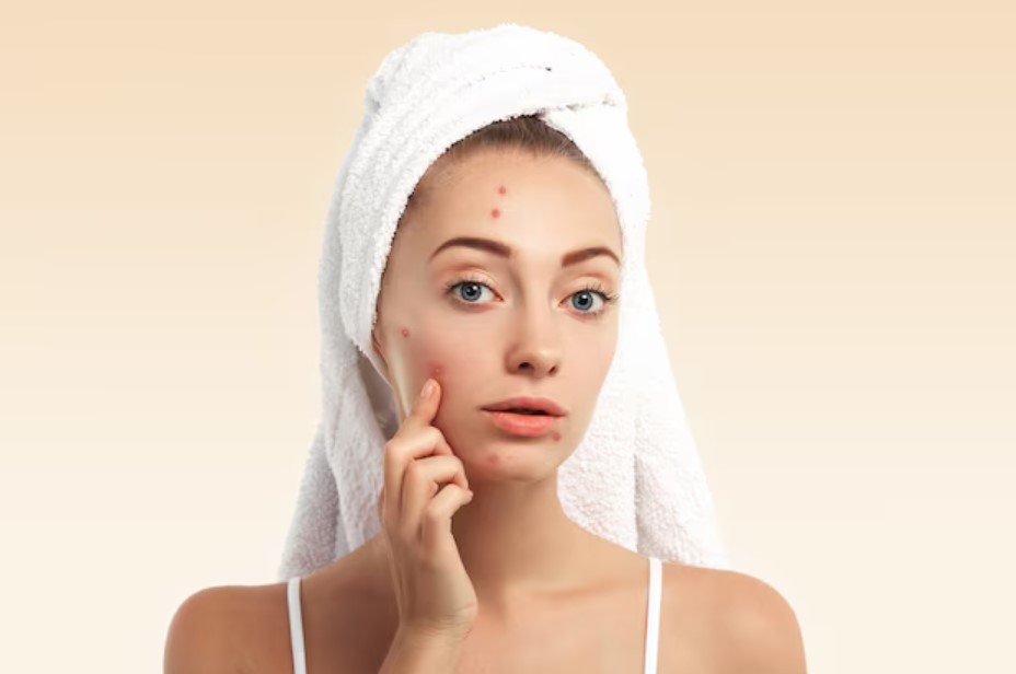 Best Acne Treatment in Delhi - Dr Rashmi Sharma