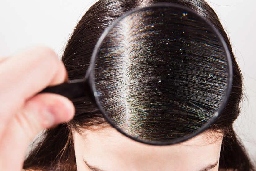 Role of a Dermatologist in Treating Scalp Conditions and Dandruff