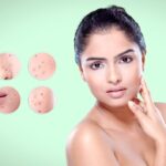 Best Dermatologist in Delhi for Acne Scars and Skin Rejuvenation