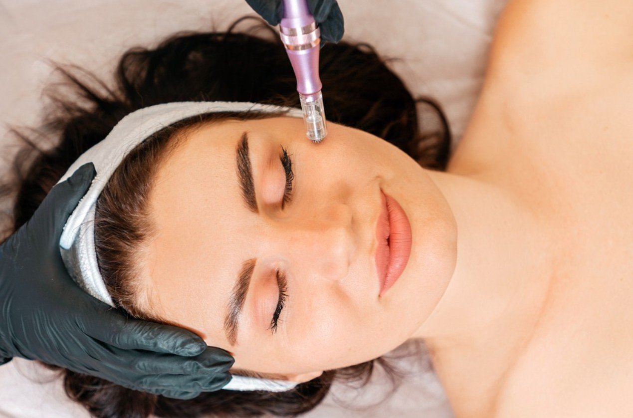 MNRF Treatment for Scars in Delhi - Dr Rashmi Sharma